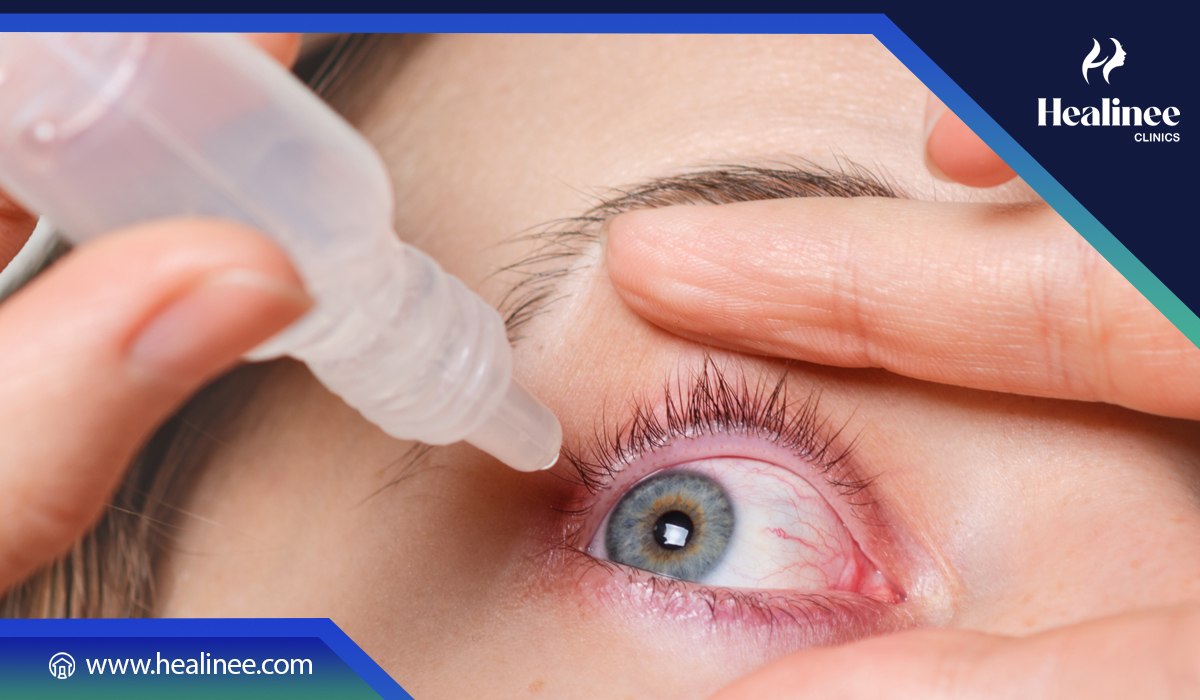 علاج جفاف العين الشديد بعد عمليات الليزك: متى يختفي وكيف يُعالج؟